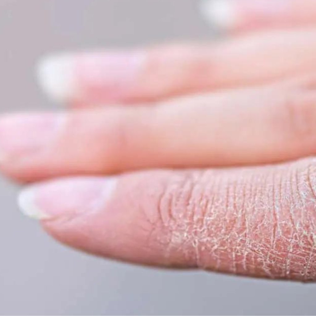 Dry Winter Skin? 7 Simple Tips to Keep You Skin Hydrated Naturally